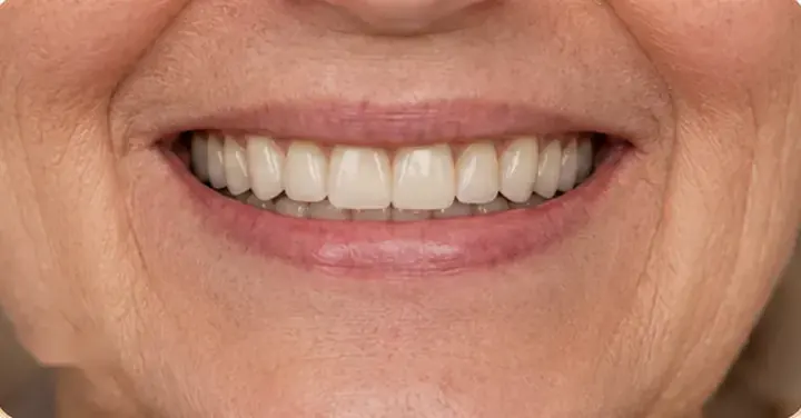 After: a full, even set of teeth