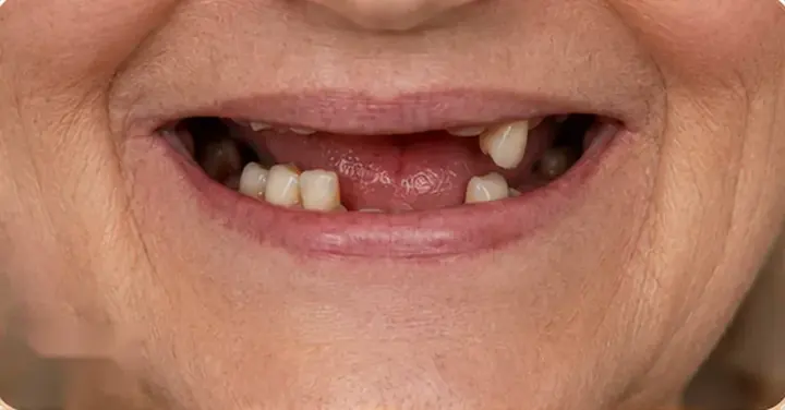 Before: only a few remaining lower teeth