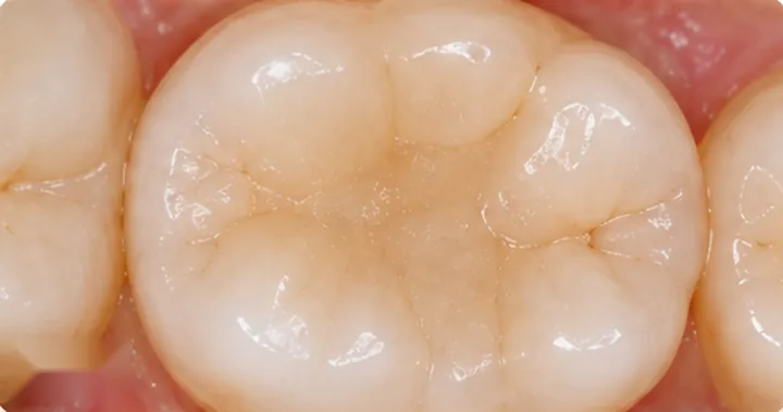 After: the same molar rebuilt in shade-matched composite