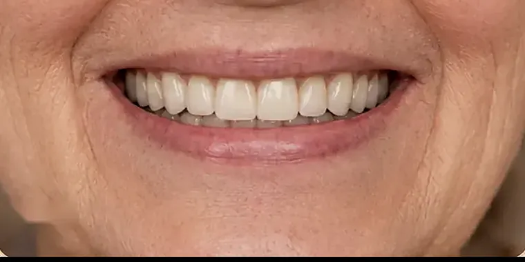 Zubní implantát zobrazený v poloze v čelisti