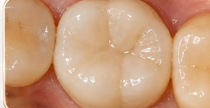 After: canals sealed and the crown rebuilt
