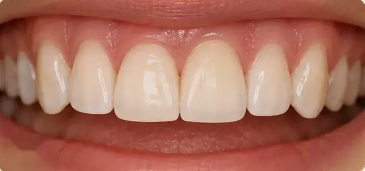 After: the gap filled with an implant crown