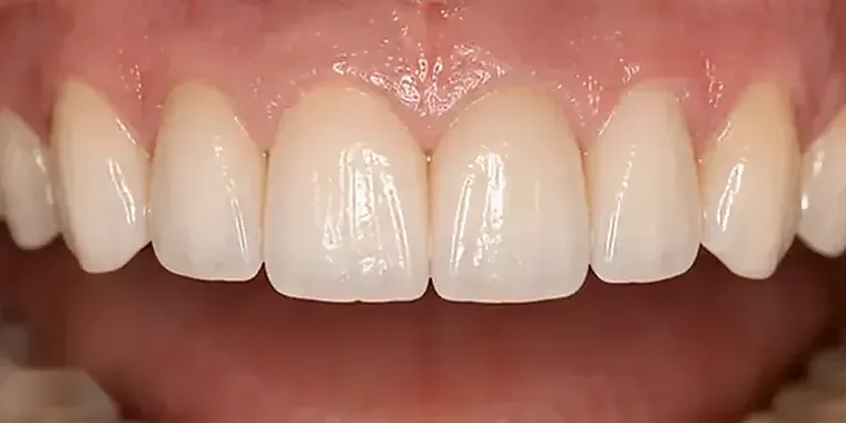 Detailní pohled na keramické práce na horních předních zubech