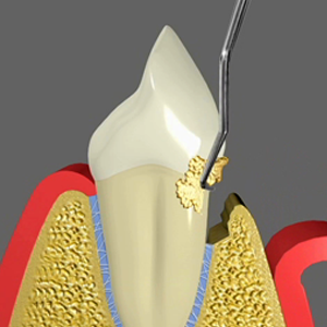 Scaling Periodontal Care