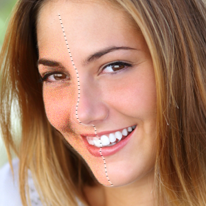 Botox treatment