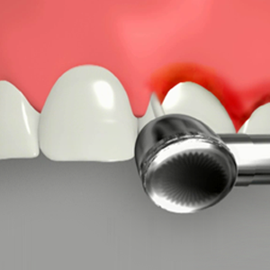 Crown lengthening