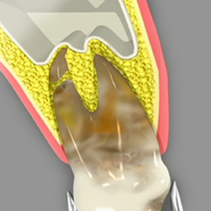 Extractions