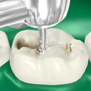 fillings
