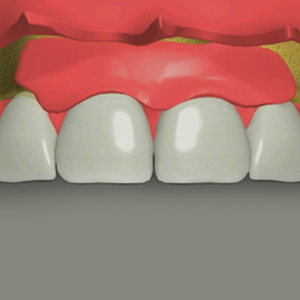 gum graft