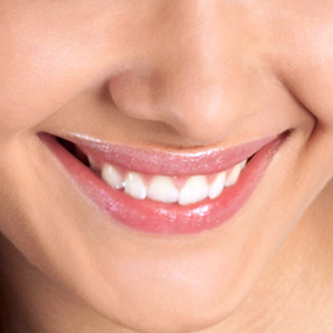 gummy smile