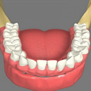 implant supported fixed dentures