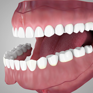 over dentures