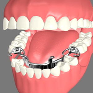 Partial dentures