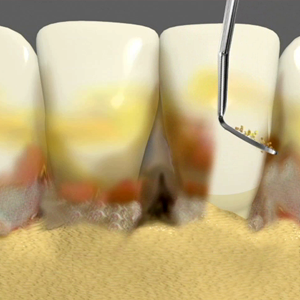 periodontal surgery