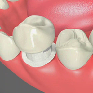 Porcelain crowns
