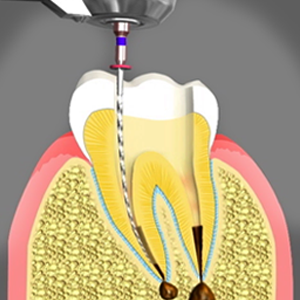 Root Canal Treatment