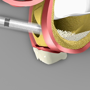 sinus grafts