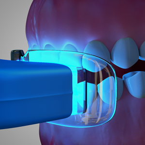 Teeth whitening