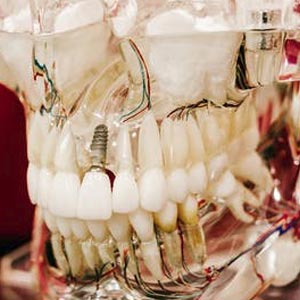 4 Signs You Need a Dental Implants