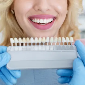 Veneers in Linden shade matching for a smiling patient during cosmetic dental treatment.