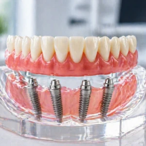 Dental model showing all on four in Colonia with full arch implant restoration