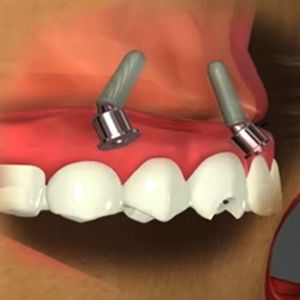 Are Same-Day Dental Implants Good?