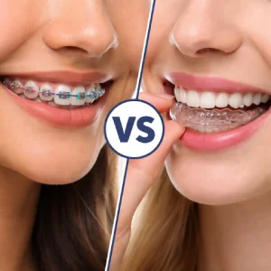 Comparison of braces and Invisalign options explained by a cosmetic dentist in Colonia