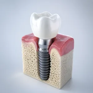 Dental implants in Scotch Plains showing a tooth implant model with crown, titanium post, gum, and jawbone structure.