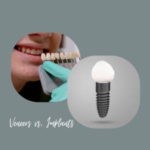 Dental Implants vs. Veneers: What's the Difference	
