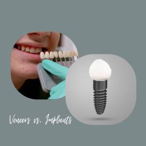 Dental Implants vs. Veneers: What's the Difference