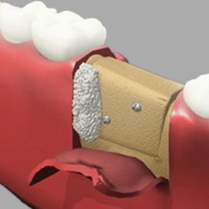 How Dental Implants Affixed With Bone Grafting? | Cranford How Dental Implants Affixed With Bone Grafting? | Cranford