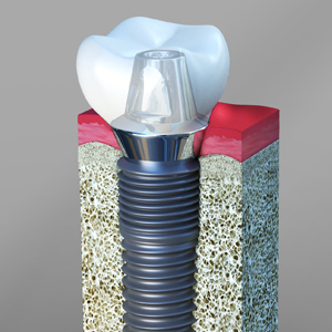 How You Can Care for Dental Implants?