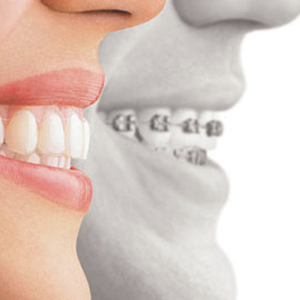Invisalign Vs Braces: Which Is Right For Smile? | Linden, NJ