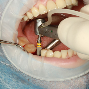 Things to Know About Dental Implants