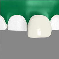 Dental Porcelain Veneers Clark, Garwood, Cranford, Winfield, Colonia, Rahway, Kenilworth, Scotch Plains, Linden